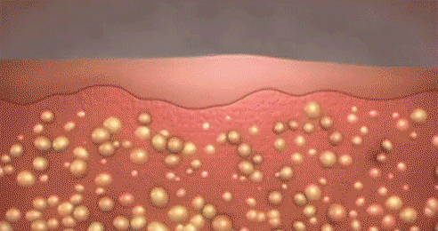 Gif-1